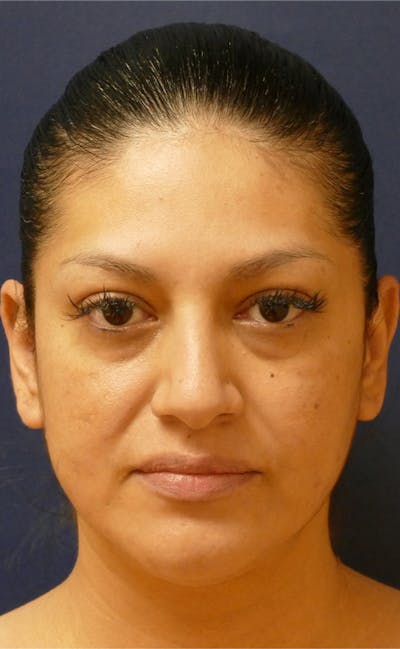 Neck Liposuction Before & After Gallery - Patient 241575 - Image 1