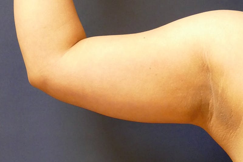 Arm Lift (Brachioplasty) Before & After Gallery - Patient 310191 - Image 7