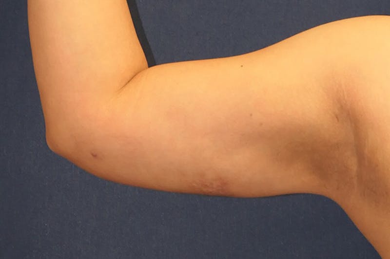 Arm Lift (Brachioplasty) Before & After Gallery - Patient 310191 - Image 8