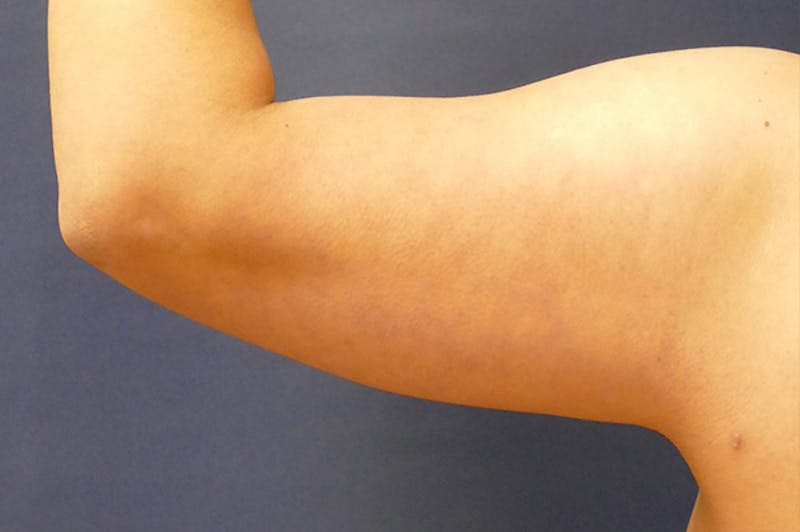 Arm Lift (Brachioplasty) Before & After Gallery - Patient 310191 - Image 5