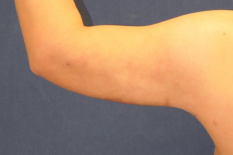 Arm Lift (Brachioplasty) Before & After Gallery - Patient 310191 - Image 6