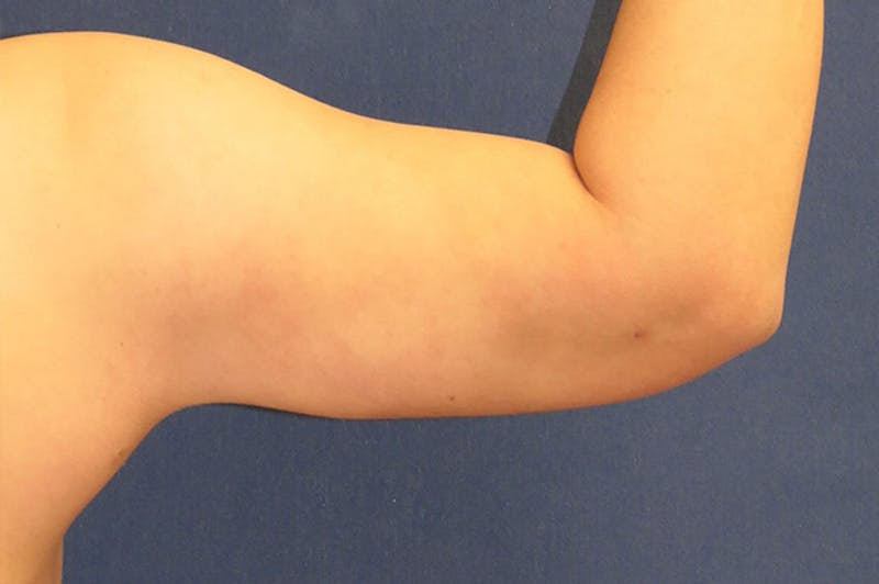 Arm Lift (Brachioplasty) Before & After Gallery - Patient 310191 - Image 4