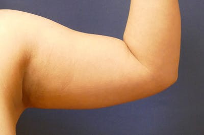 Arm Lift (Brachioplasty) Before & After Gallery - Patient 310191 - Image 1