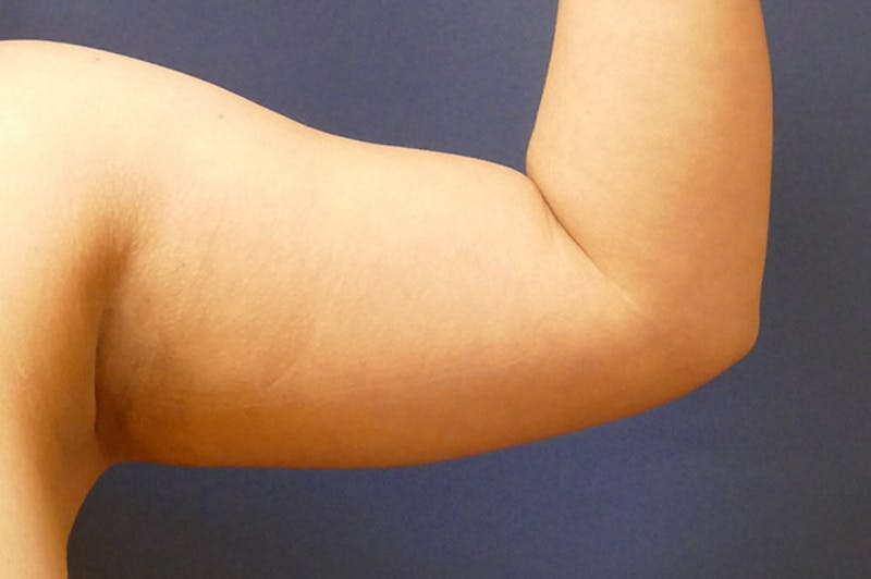 Arm Lift (Brachioplasty) Before & After Gallery - Patient 310191 - Image 1