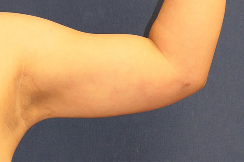 Arm Lift (Brachioplasty) Before & After Gallery - Patient 310191 - Image 2