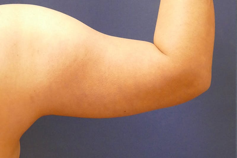 Arm Lift (Brachioplasty) Before & After Gallery - Patient 310191 - Image 3