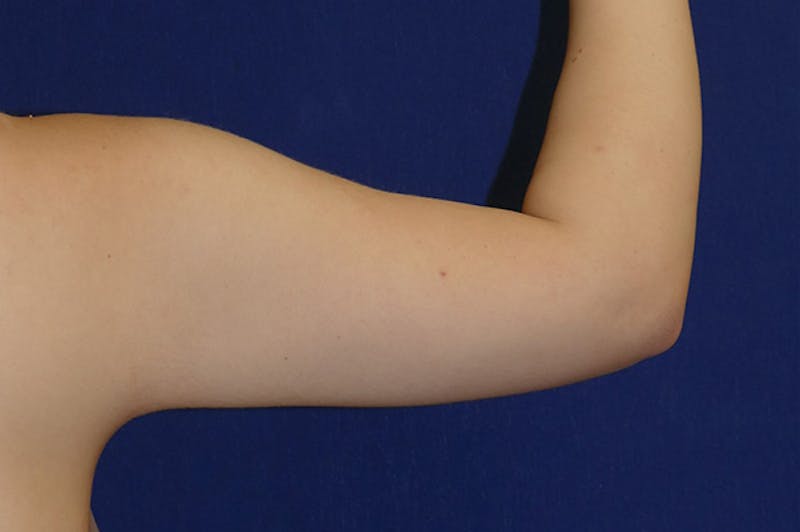 Arm Lift (Brachioplasty) Before & After Gallery - Patient 273508 - Image 7