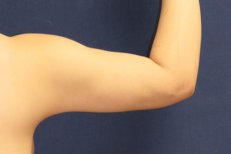 Arm Lift (Brachioplasty) Before & After Gallery - Patient 273508 - Image 8