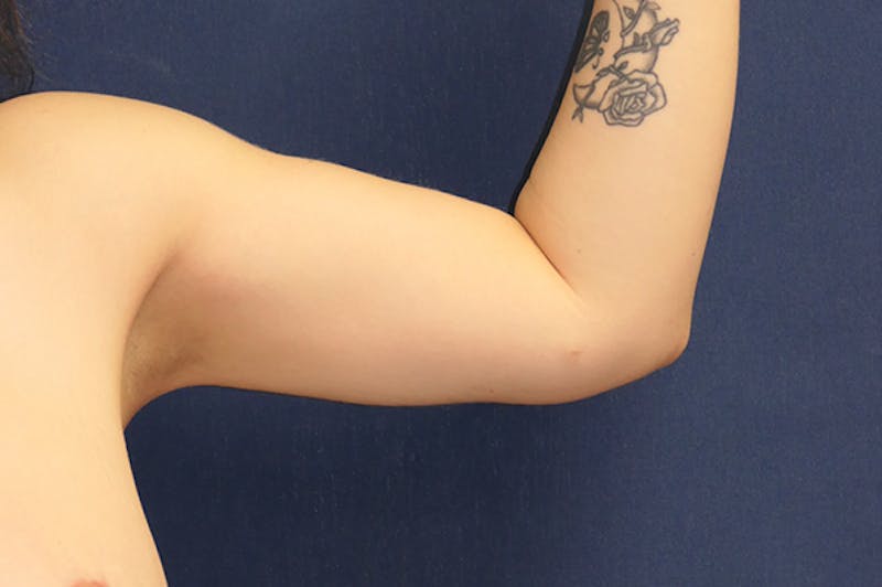 Arm Lift (Brachioplasty) Before & After Gallery - Patient 273508 - Image 6