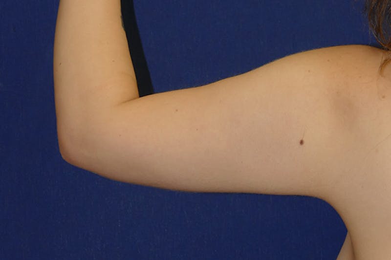 Arm Lift (Brachioplasty) Before & After Gallery - Patient 273508 - Image 3