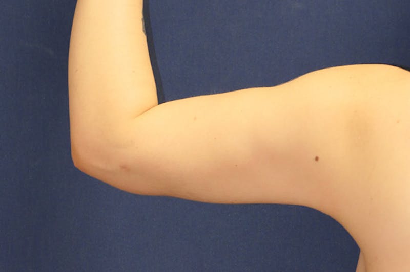 Arm Lift (Brachioplasty) Before & After Gallery - Patient 273508 - Image 4