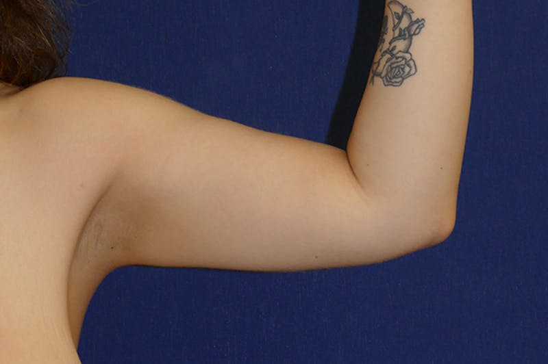 Arm Lift (Brachioplasty) Before & After Gallery - Patient 273508 - Image 5