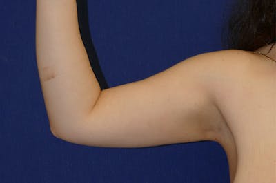 Arm Lift (Brachioplasty) Before & After Gallery - Patient 273508 - Image 1