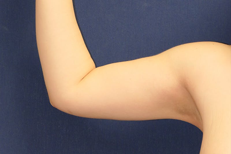 Arm Lift (Brachioplasty) Before & After Gallery - Patient 273508 - Image 2