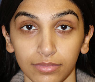 Ear Pinning (Otoplasty) Before & After Gallery - Patient 760466 - Image 2