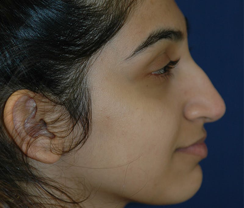 Ear Pinning (Otoplasty) Before & After Gallery - Patient 760466 - Image 3