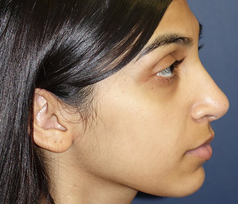 Ear Pinning (Otoplasty) Before & After Gallery - Patient 760466 - Image 4