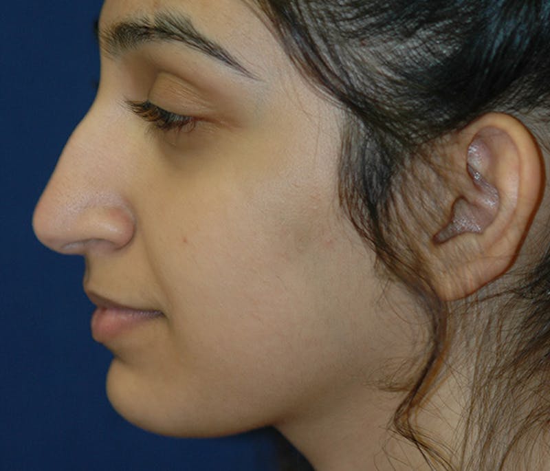 Ear Pinning (Otoplasty) Before & After Gallery - Patient 760466 - Image 5