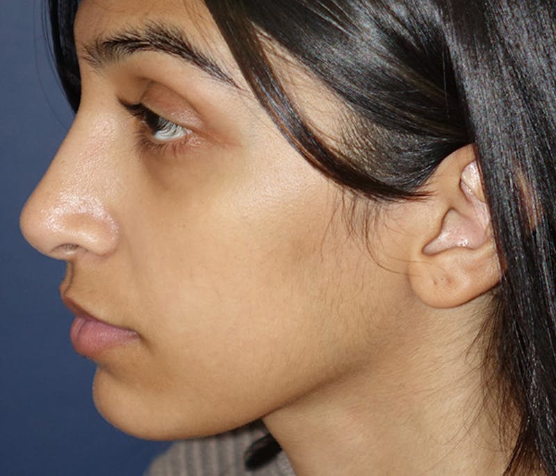 Ear Pinning (Otoplasty) Before & After Gallery - Patient 760466 - Image 6