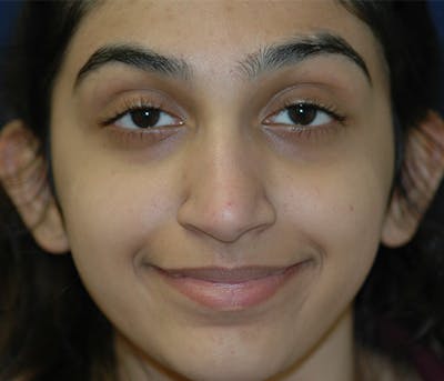 Ear Pinning (Otoplasty) Before & After Gallery - Patient 760466 - Image 1