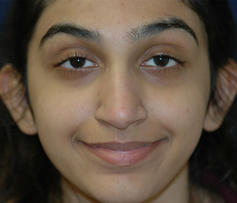 Ear Pinning (Otoplasty) Before & After Gallery - Patient 760466 - Image 1
