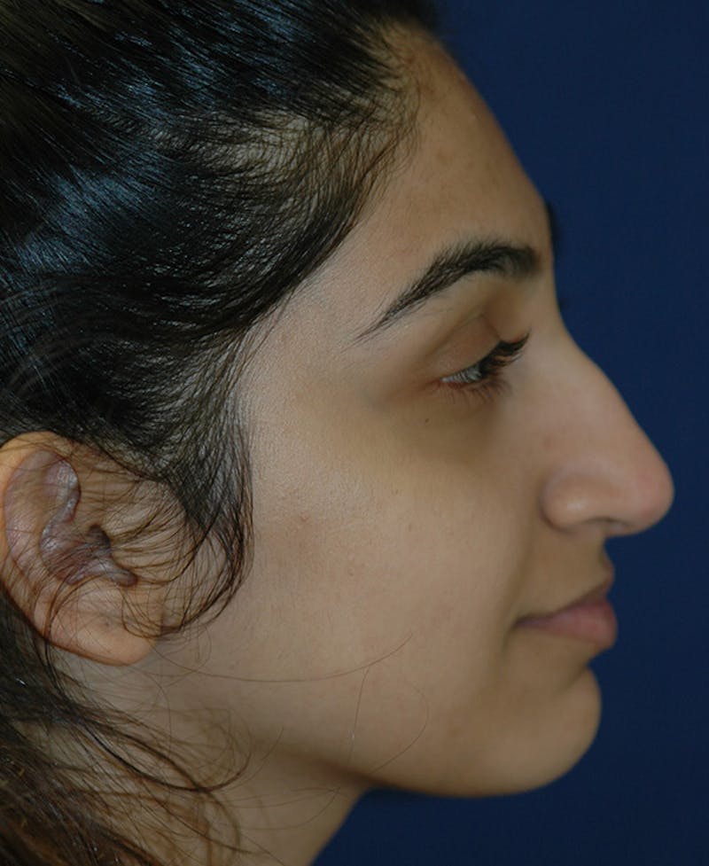 Rhinoplasty Before & After Gallery - Patient 164002 - Image 3