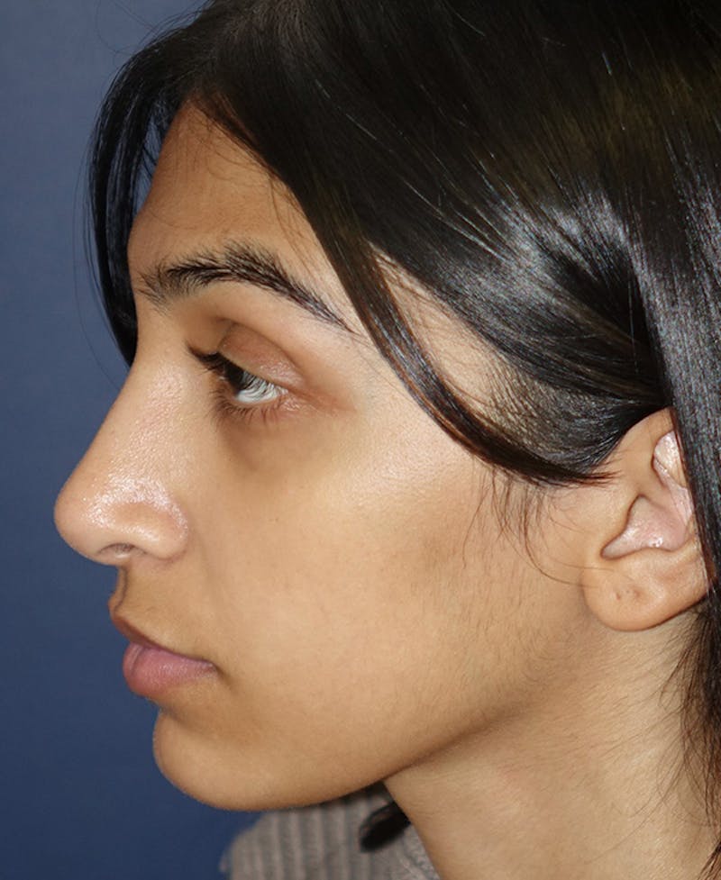 Rhinoplasty Before & After Gallery - Patient 164002 - Image 6