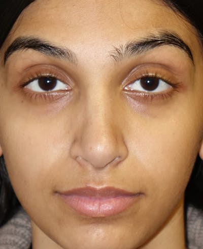 Rhinoplasty Before & After Gallery - Patient 164002 - Image 2