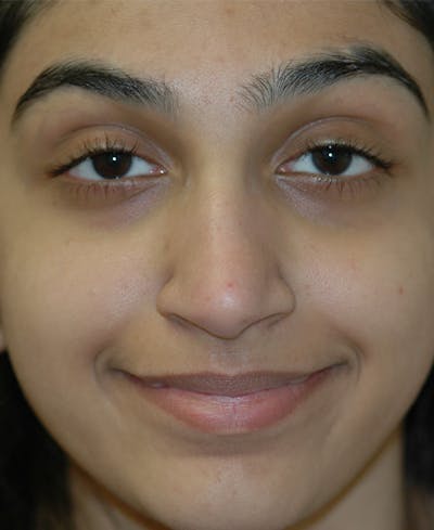 Rhinoplasty Before & After Gallery - Patient 164002 - Image 1