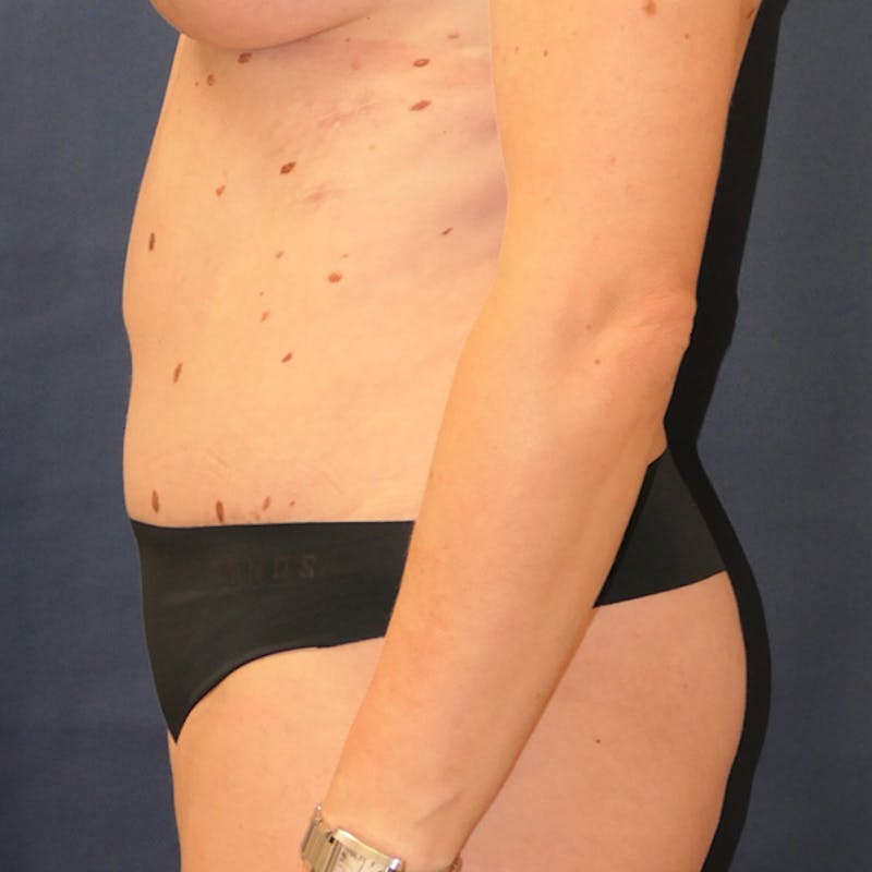 Tummy Tuck (Abdominoplasty) Before & After Gallery - Patient 378752 - Image 6