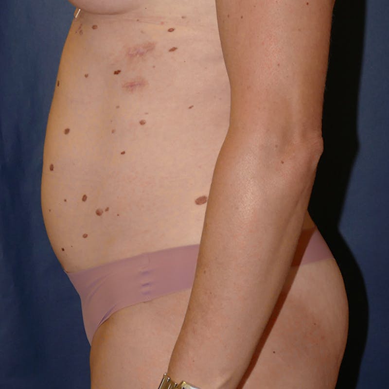 Tummy Tuck (Abdominoplasty) Before & After Gallery - Patient 378752 - Image 5