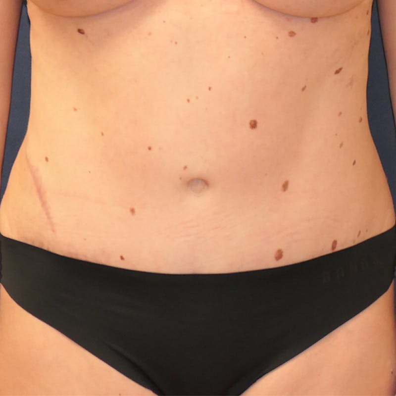 Tummy Tuck (Abdominoplasty) Before & After Gallery - Patient 378752 - Image 2
