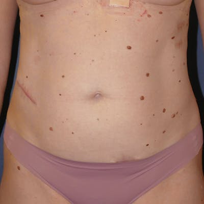 Tummy Tuck (Abdominoplasty) Before & After Gallery - Patient 378752 - Image 1