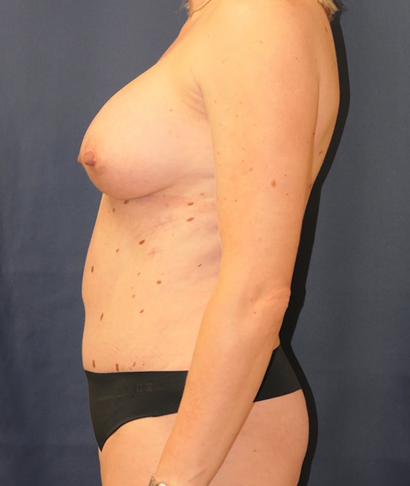 Breast Augmentation Before & After Gallery - Patient 375552 - Image 6