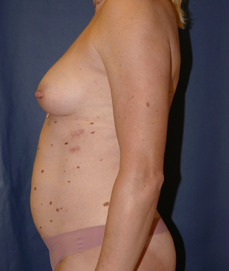 Breast Augmentation Before & After Gallery - Patient 375552 - Image 5