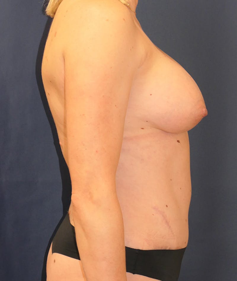 Breast Augmentation Before & After Gallery - Patient 375552 - Image 4