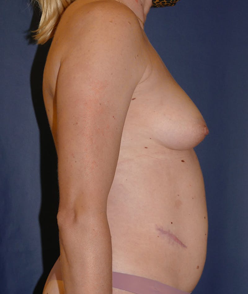Breast Augmentation Before & After Gallery - Patient 375552 - Image 3