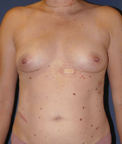 Breast Augmentation Before & After Gallery - Patient 375552 - Image 1