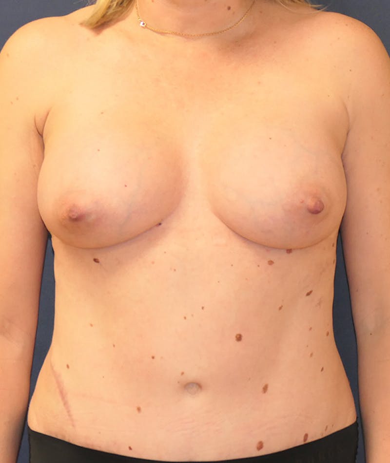 Breast Augmentation Before & After Gallery - Patient 375552 - Image 2