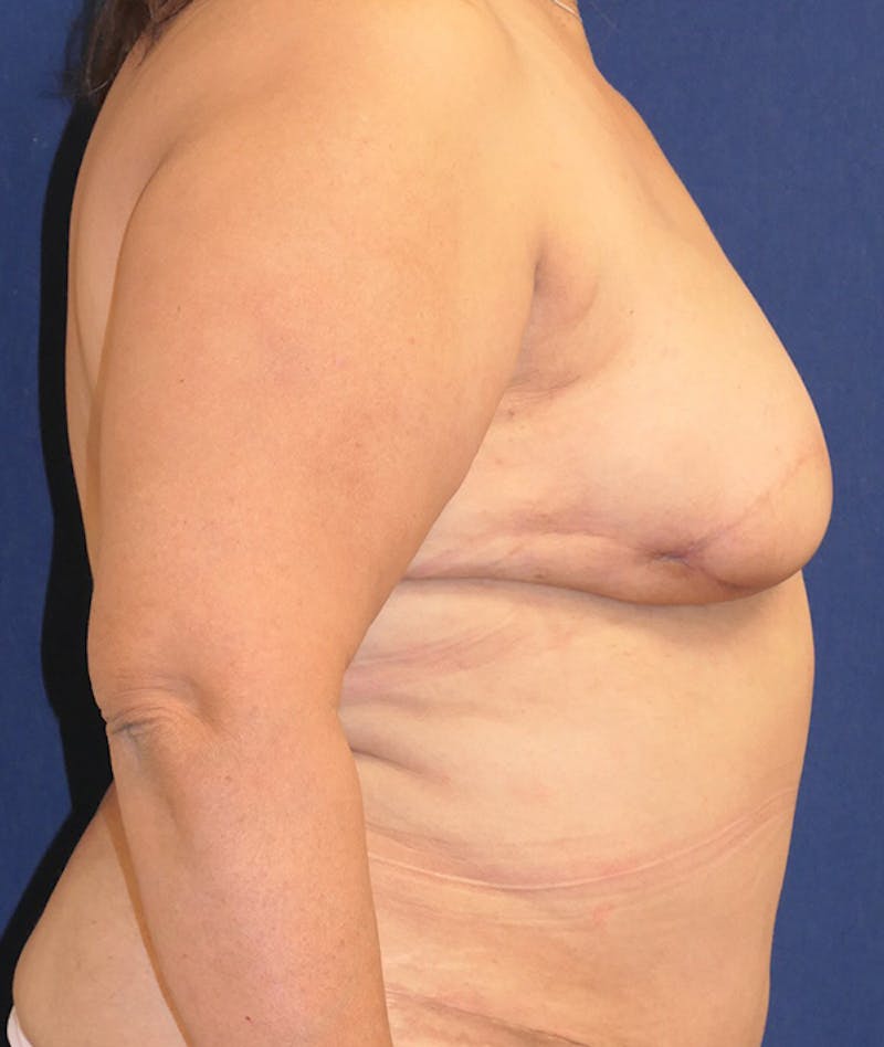 Breast Reconstruction with Autologous Tissue Before & After Gallery - Patient 359635 - Image 6