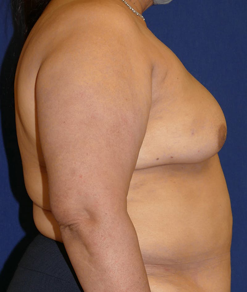 Breast Reconstruction with Autologous Tissue Before & After Gallery - Patient 359635 - Image 5