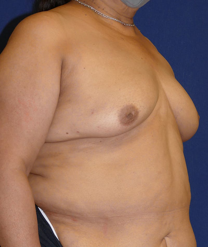 Breast Reconstruction with Autologous Tissue Before & After Gallery - Patient 359635 - Image 3