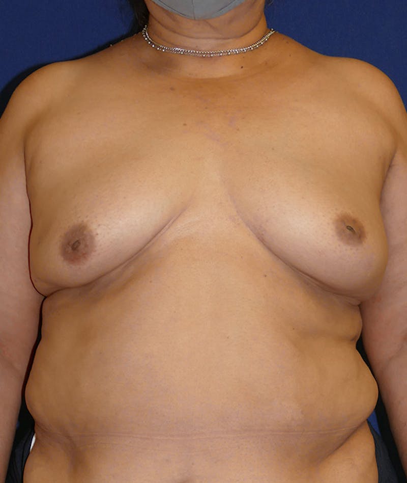 Breast Reconstruction with Autologous Tissue Before & After Gallery - Patient 359635 - Image 1