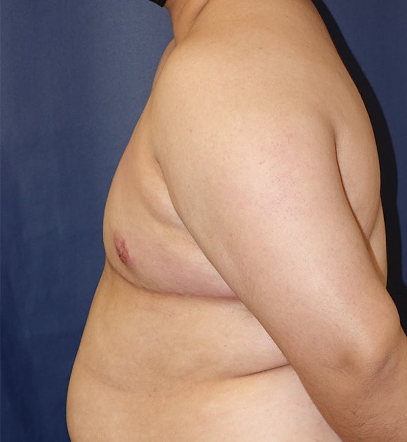 Masculinizing Surgery Before & After Gallery - Patient 244424 - Image 6