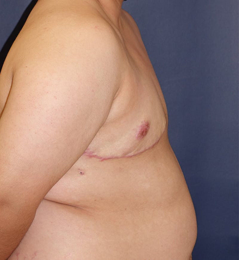 Masculinizing Surgery Before & After Gallery - Patient 244424 - Image 4