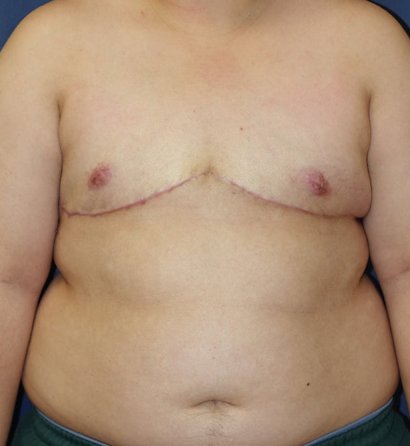 Masculinizing Surgery Before & After Gallery - Patient 244424 - Image 2