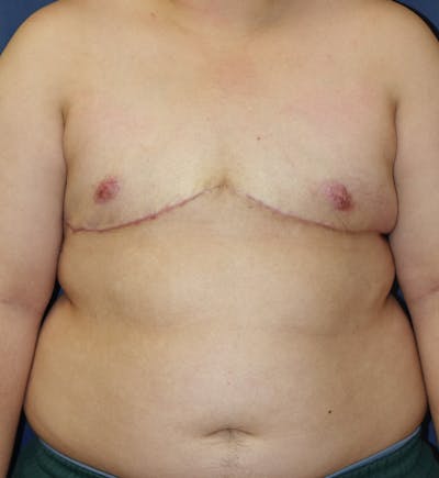 Masculinizing Surgery Before & After Gallery - Patient 244424 - Image 2