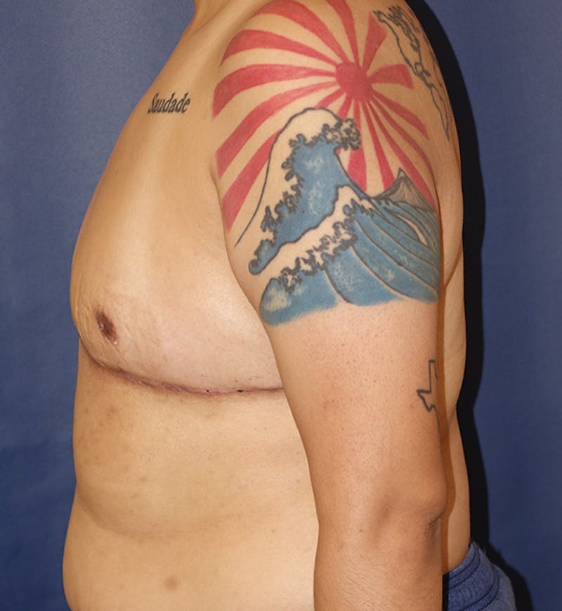 Masculinizing Surgery Before & After Gallery - Patient 732737 - Image 6
