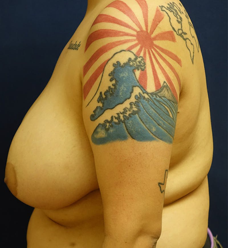 Masculinizing Surgery Before & After Gallery - Patient 732737 - Image 5