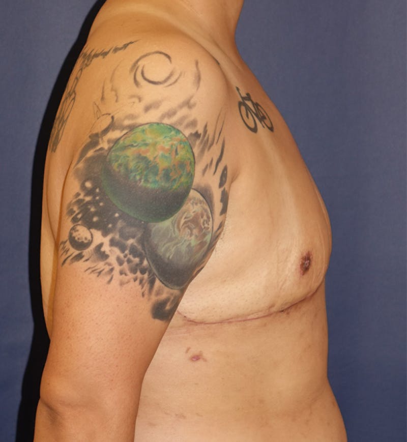 Masculinizing Surgery Before & After Gallery - Patient 732737 - Image 4